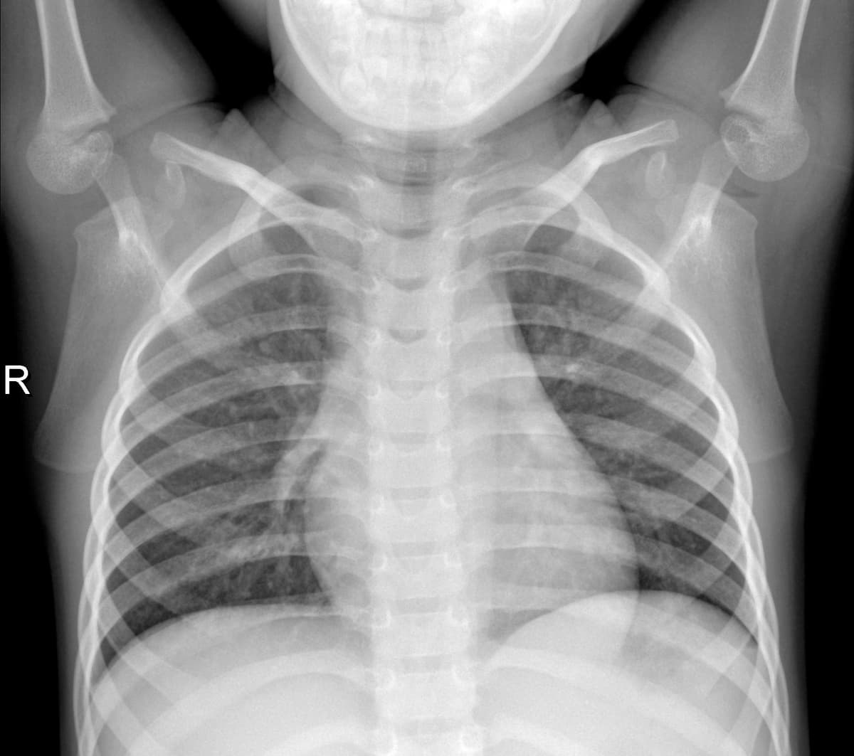 Radiografia Normal — NIH Chest X-ray14