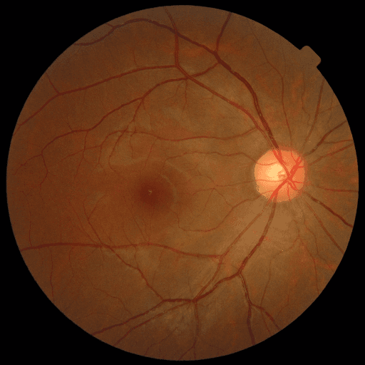 No Diabetic Retinopathy — MESSIDOR-2