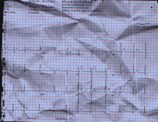 Normal ECG — PTB-XL