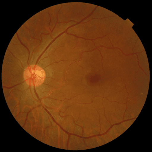 No Diabetic Retinopathy — MESSIDOR-2