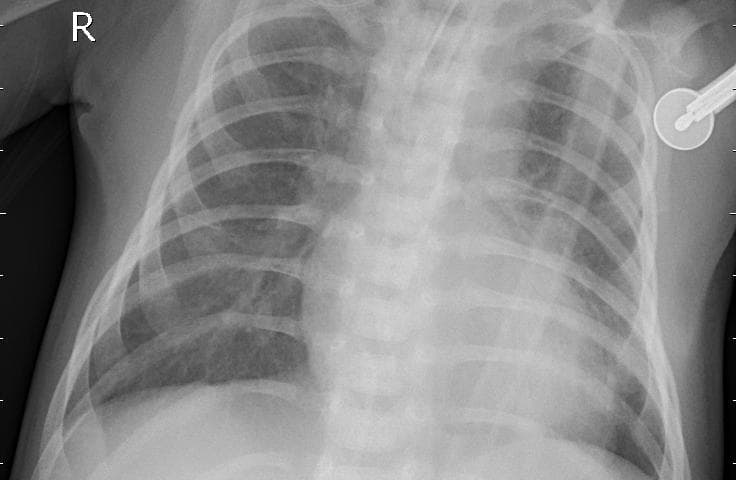 Pneumonia — NIH Chest X-ray14