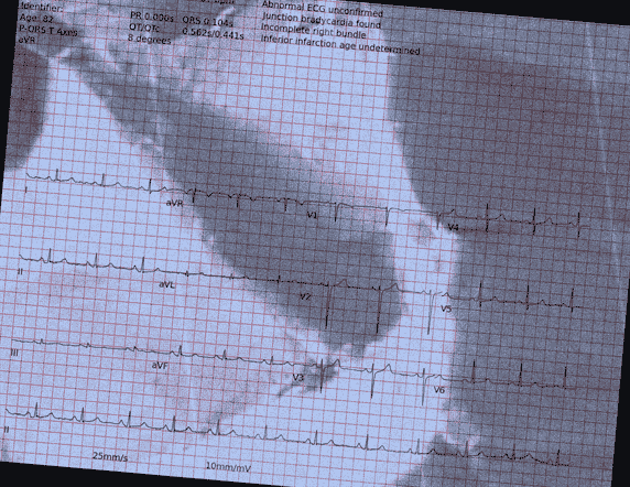 Normal ECG — PTB-XL