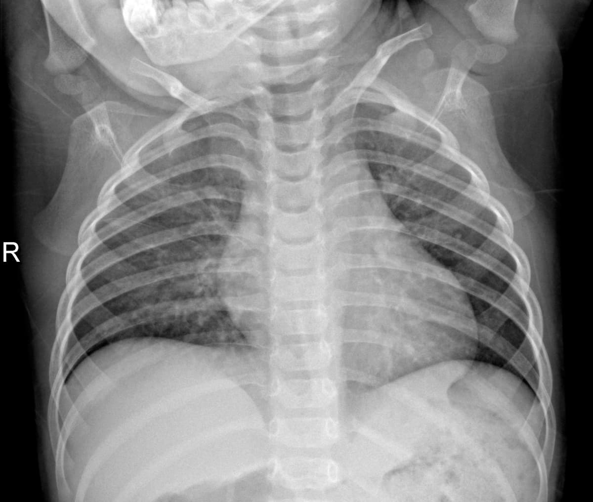 Radiografia Normal — NIH Chest X-ray14