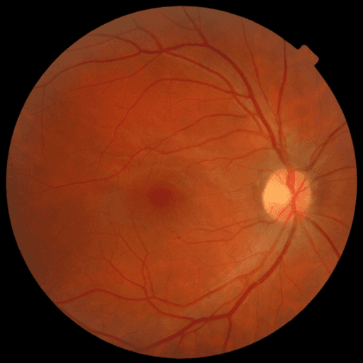No Diabetic Retinopathy — MESSIDOR-2