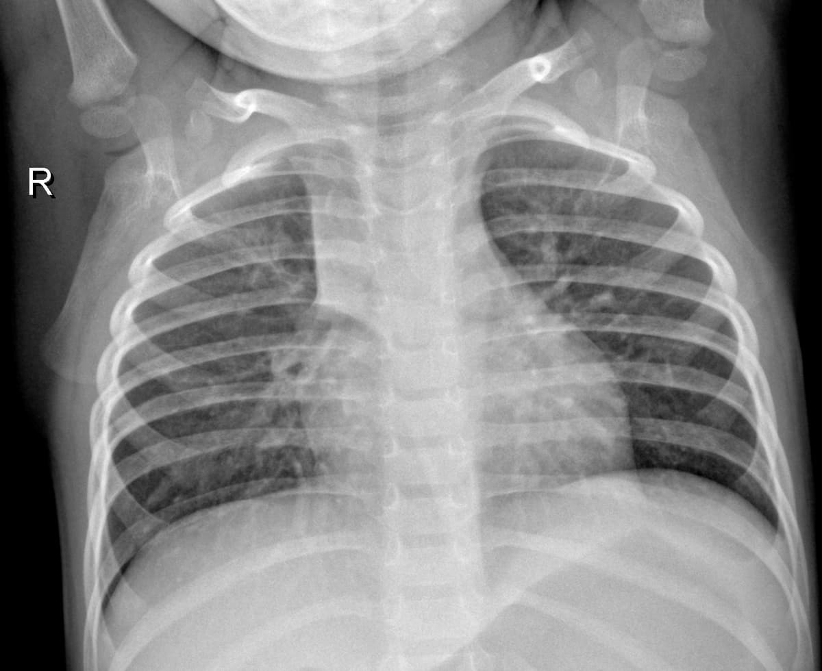 Radiografia Normal — NIH Chest X-ray14