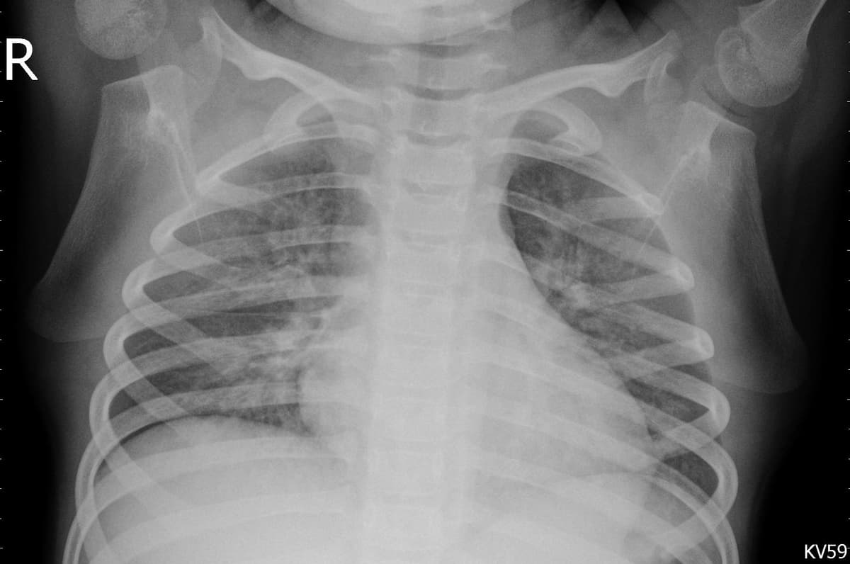 Pneumonia — NIH Chest X-ray14