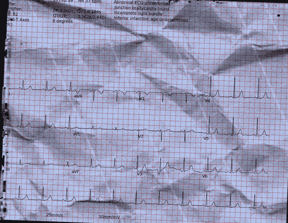 Normal ECG — PTB-XL