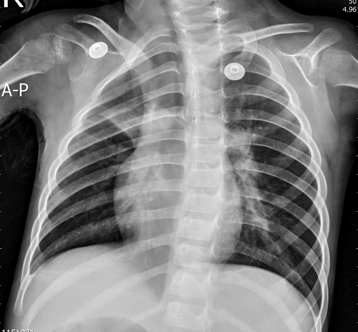 Pneumonia — NIH Chest X-ray14