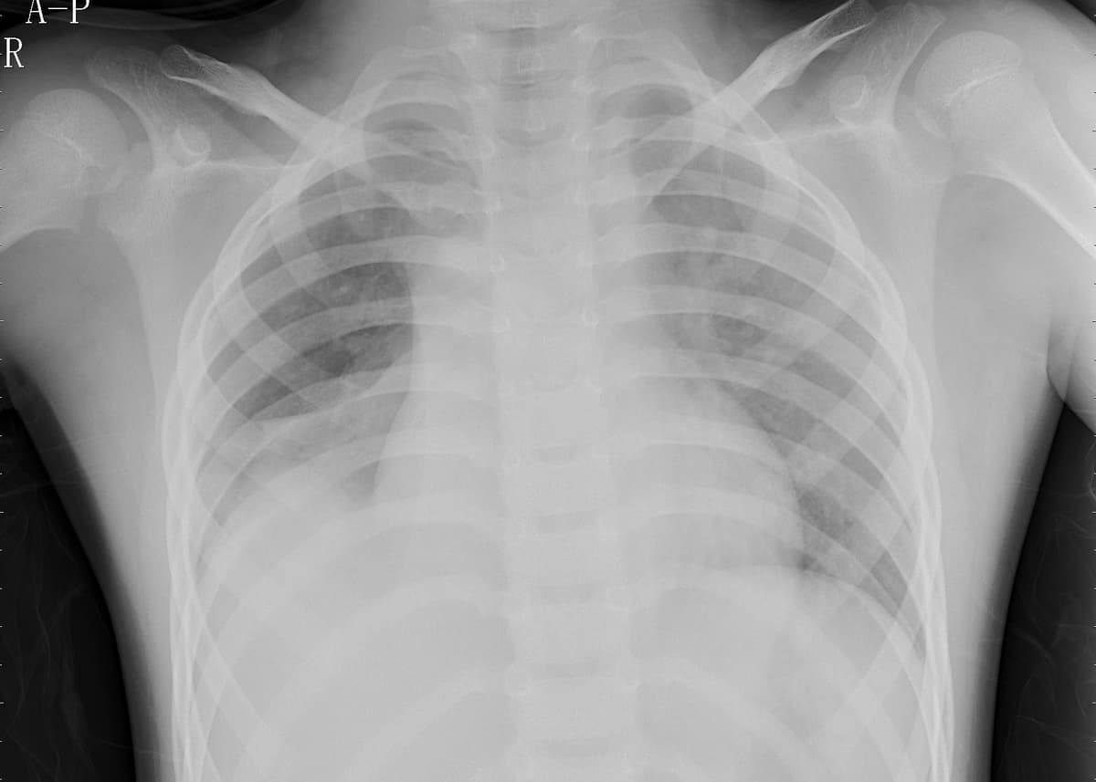 Pneumonia — NIH Chest X-ray14