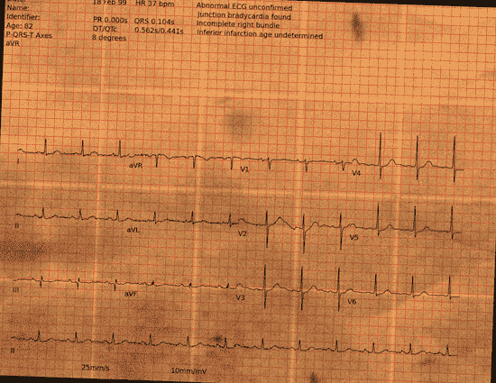 Normal ECG — PTB-XL