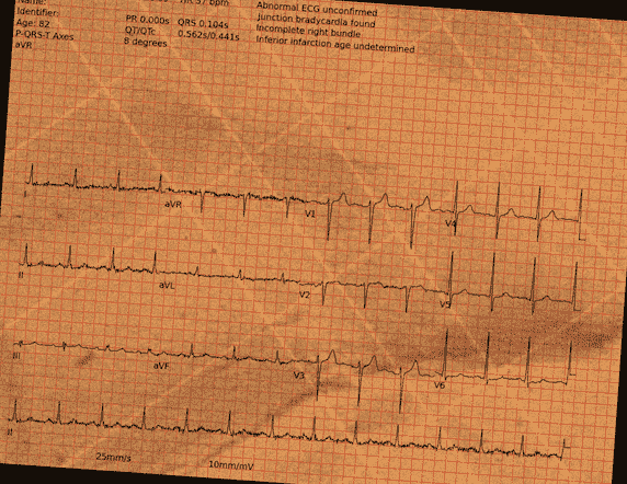 Normal ECG — PTB-XL