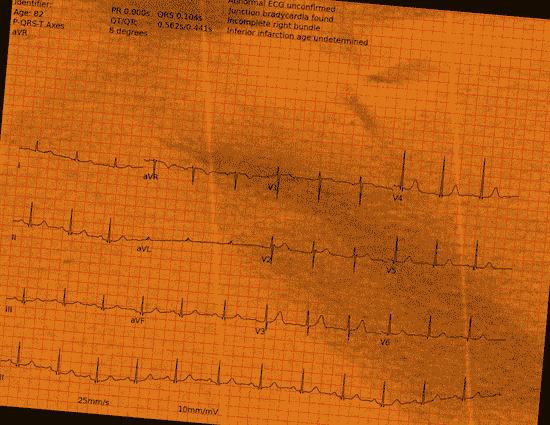 Normal ECG — PTB-XL