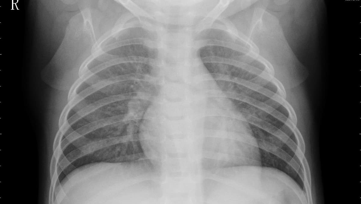 Pneumonia — NIH Chest X-ray14