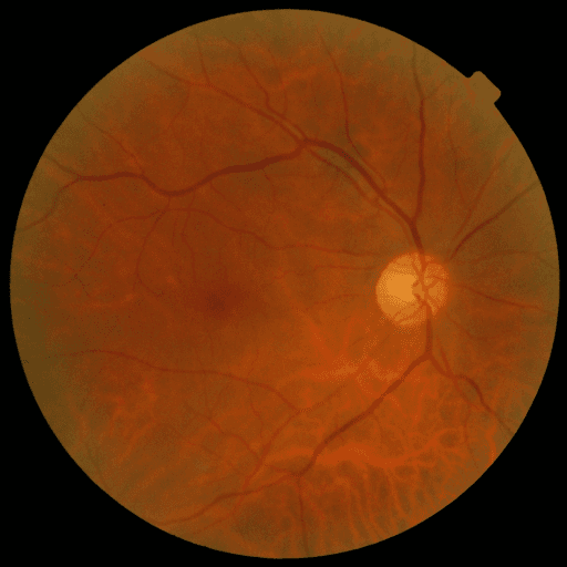 No Diabetic Retinopathy — MESSIDOR-2