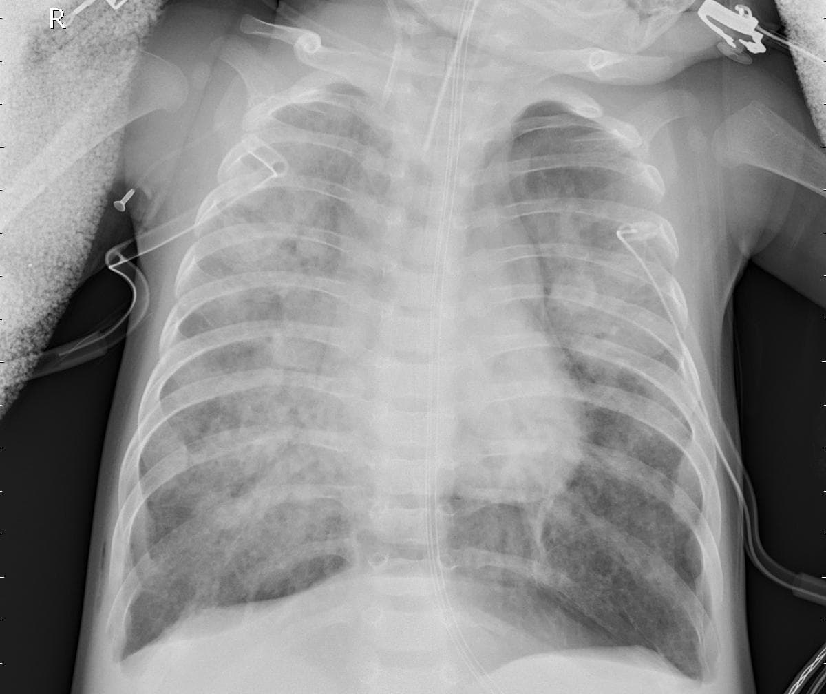 Pneumonia — NIH Chest X-ray14