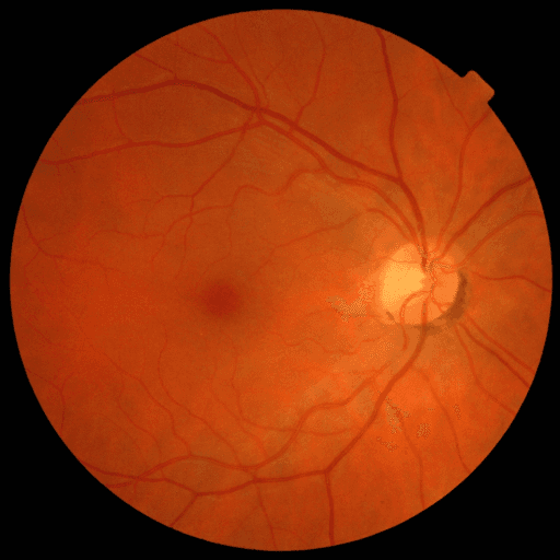 Proliferative DR — MESSIDOR-2