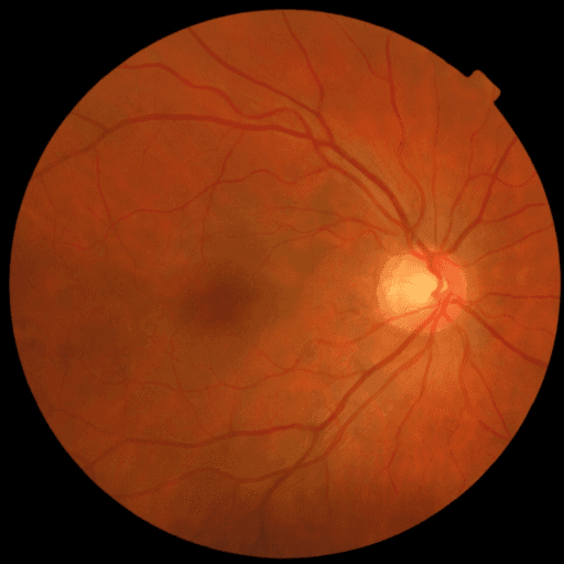 No Diabetic Retinopathy — MESSIDOR-2