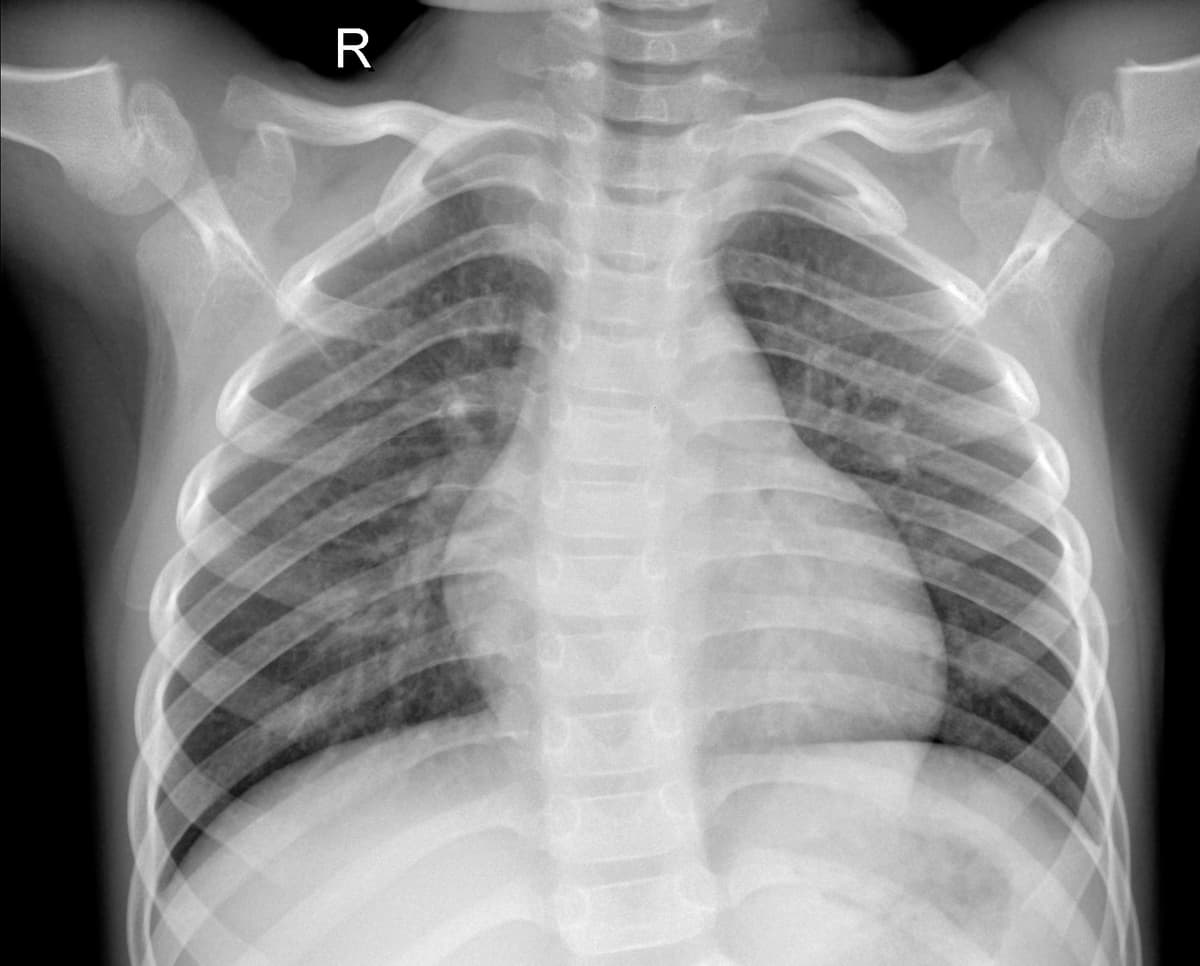 Radiografia Normal — NIH Chest X-ray14