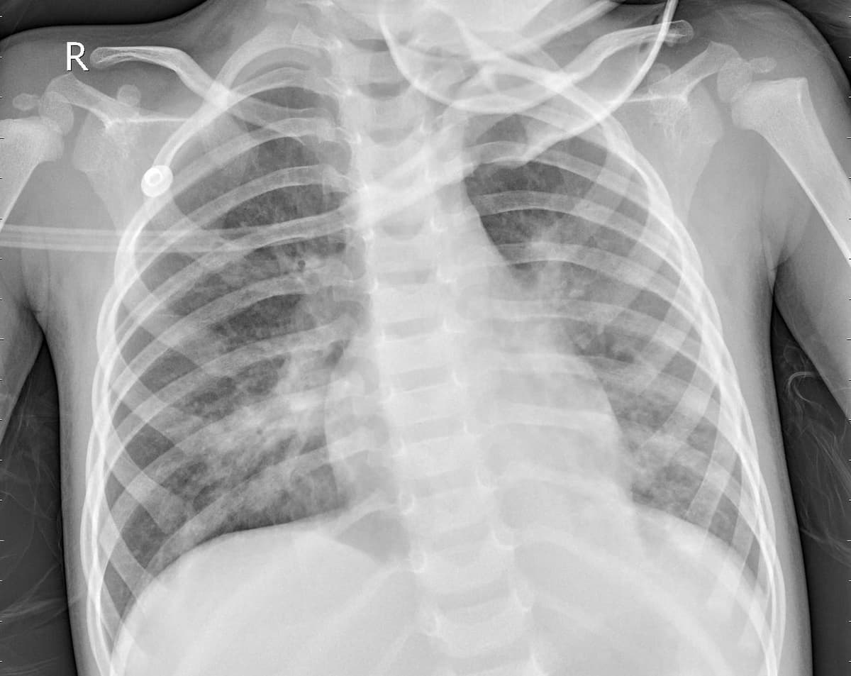 Pneumonia — NIH Chest X-ray14