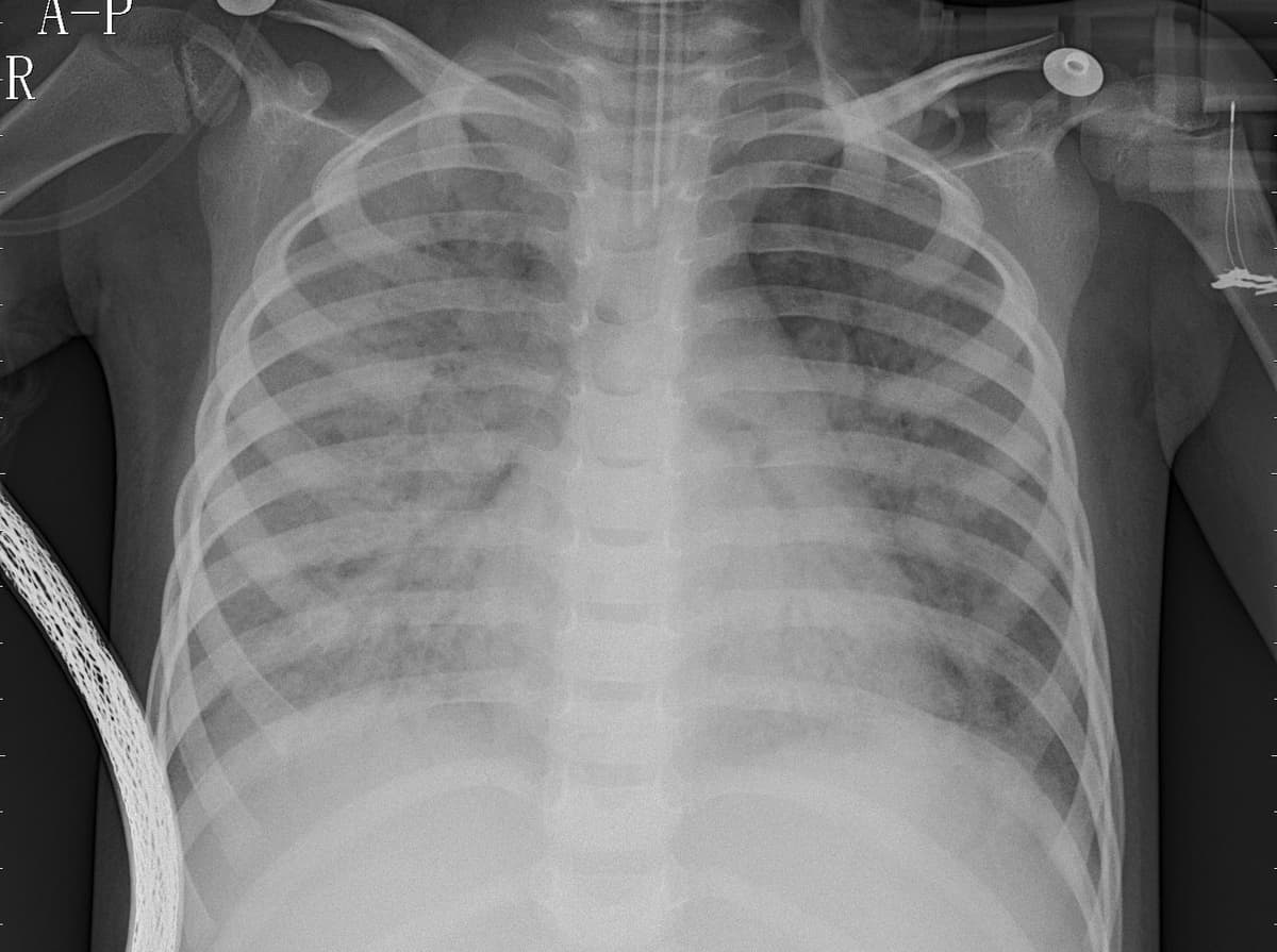 Pneumonia — NIH Chest X-ray14