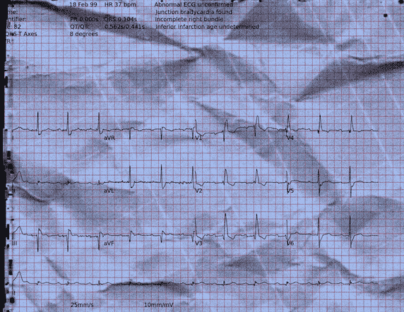 Normal ECG — PTB-XL