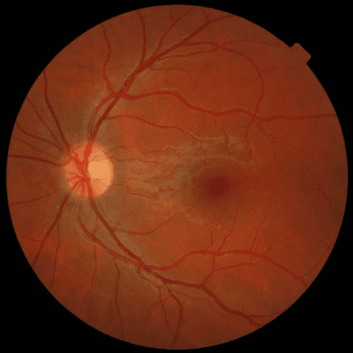 No Diabetic Retinopathy — MESSIDOR-2