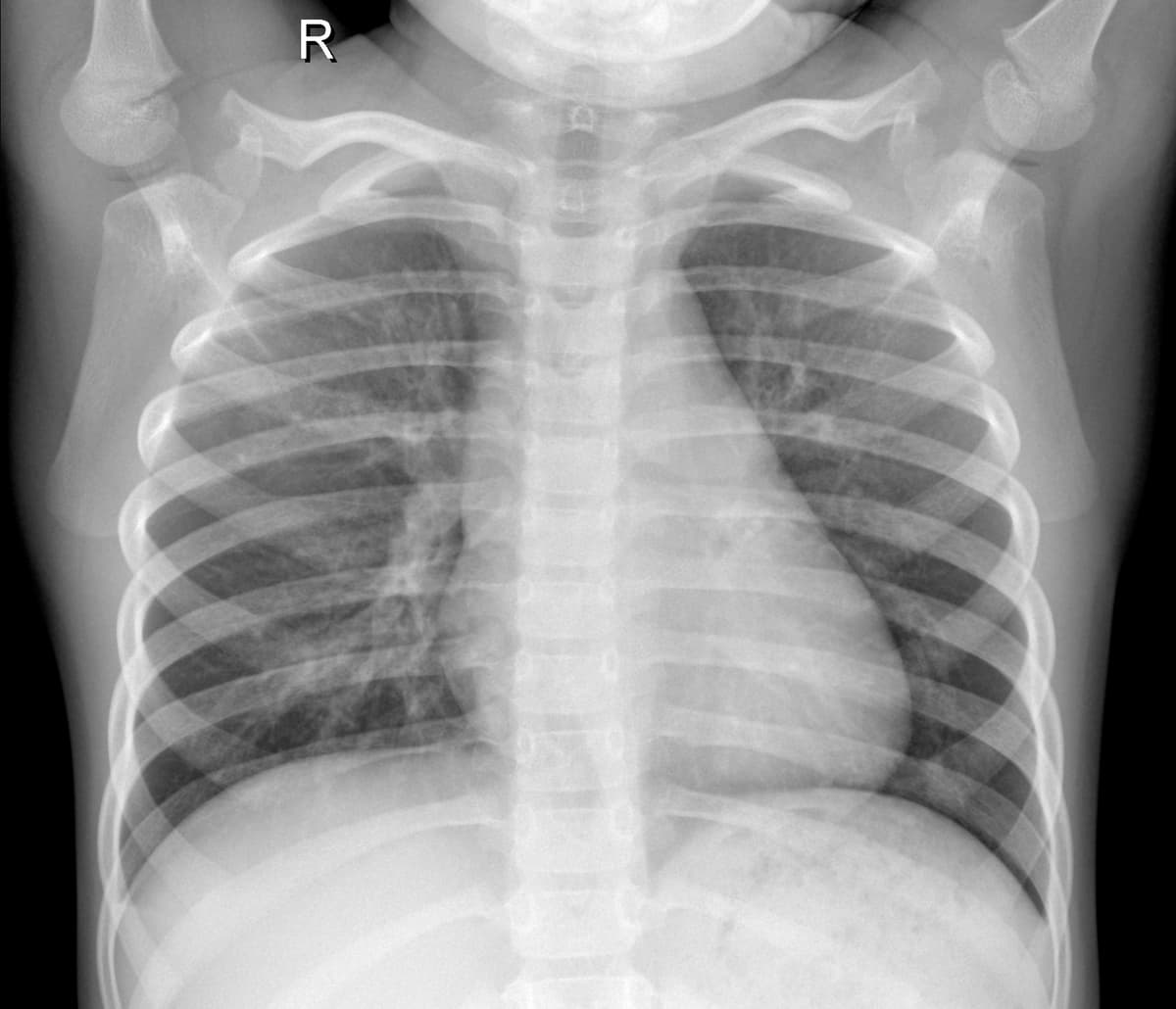 Radiografia Normal — NIH Chest X-ray14