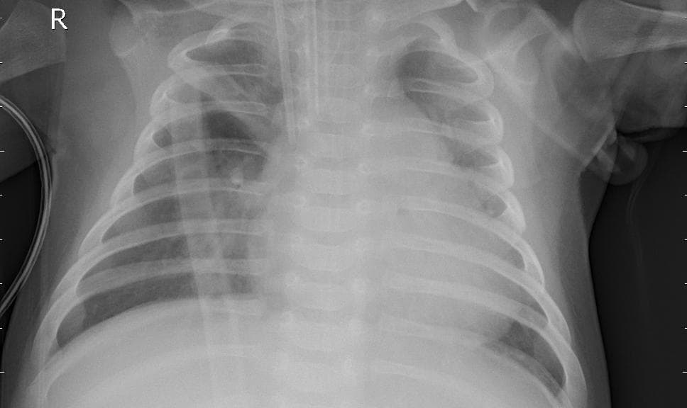 Pneumonia — NIH Chest X-ray14