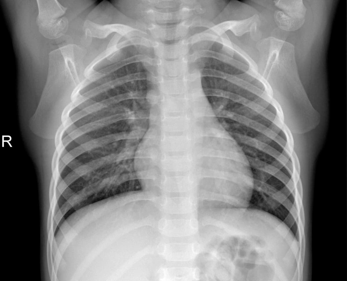 Radiografia Normal — NIH Chest X-ray14