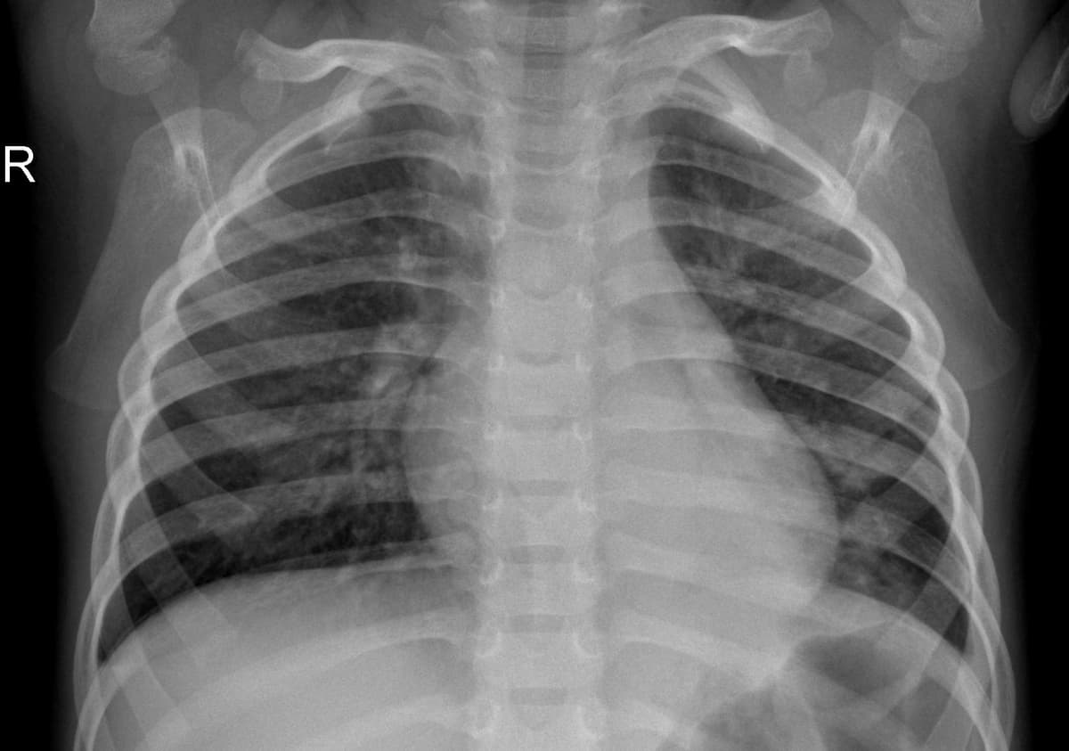 Pneumonia — NIH Chest X-ray14