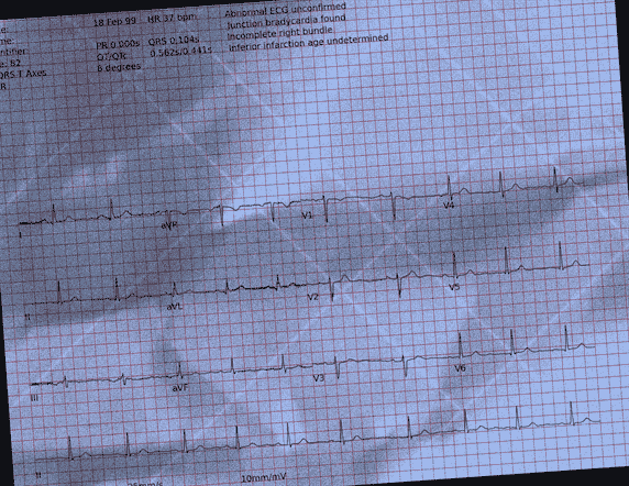 Normal ECG — PTB-XL