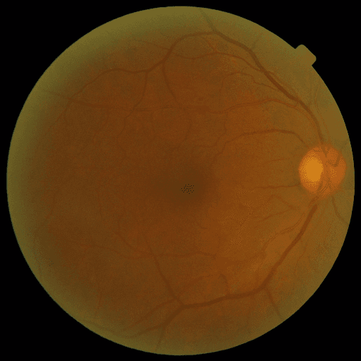 No Diabetic Retinopathy — MESSIDOR-2