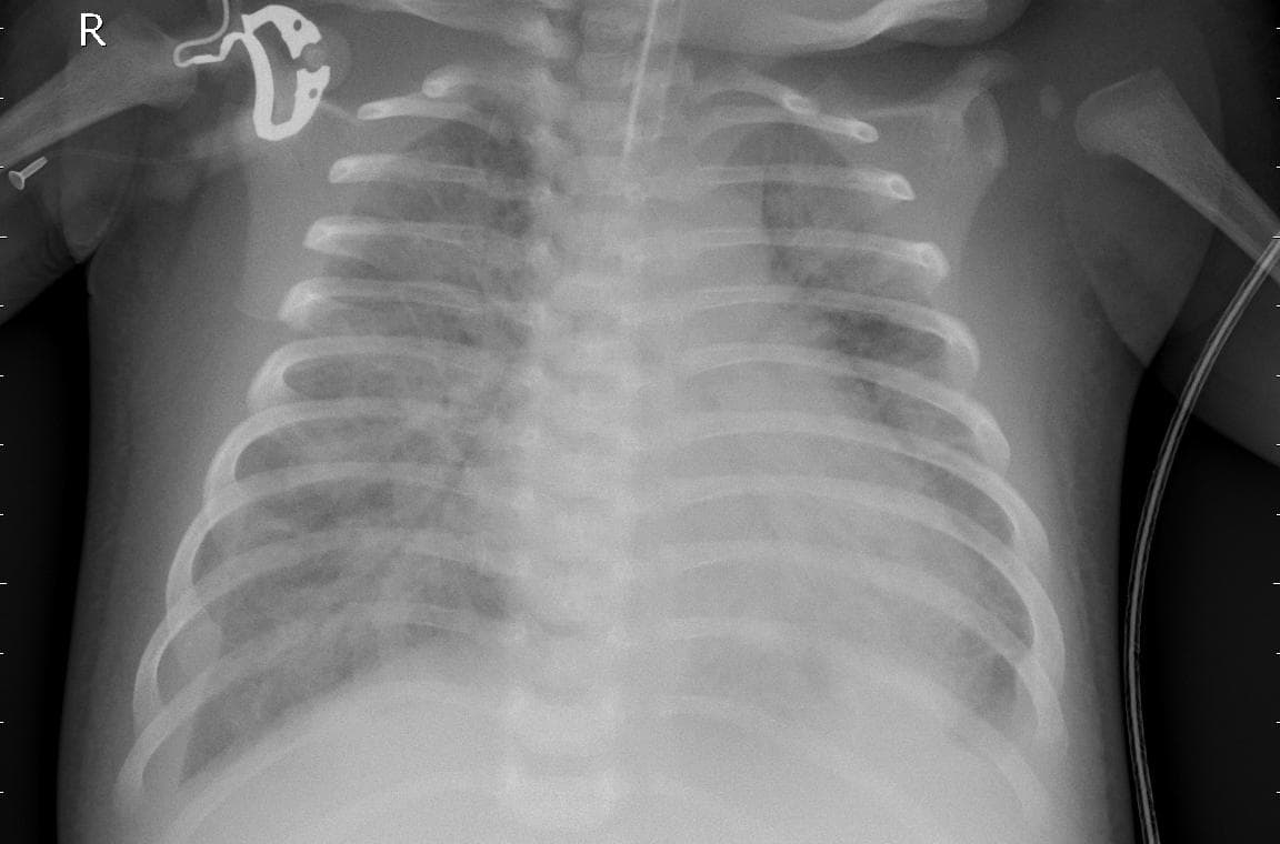 Pneumonia — NIH Chest X-ray14