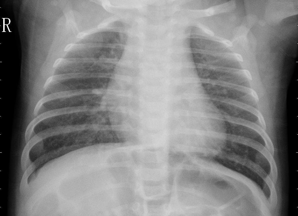 Pneumonia — NIH Chest X-ray14
