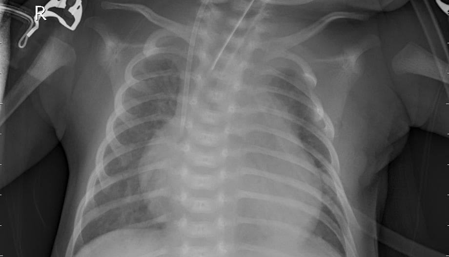 Pneumonia — NIH Chest X-ray14