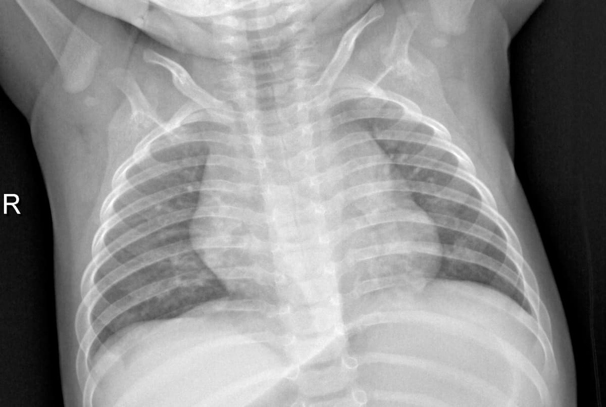 Radiografia Normal — NIH Chest X-ray14