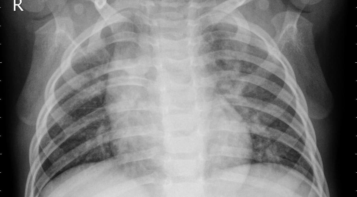 Pneumonia — NIH Chest X-ray14