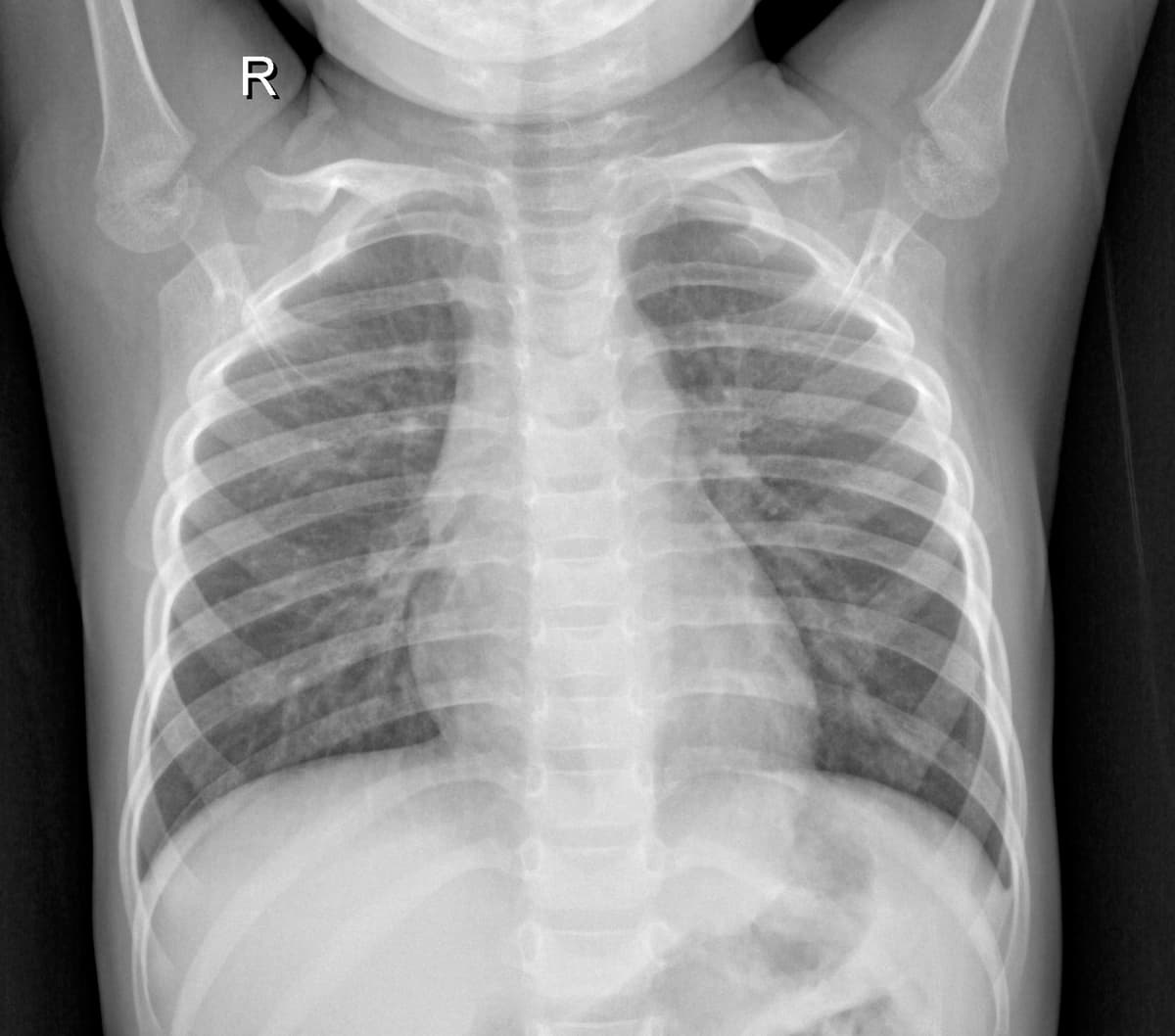 Radiografia Normal — NIH Chest X-ray14