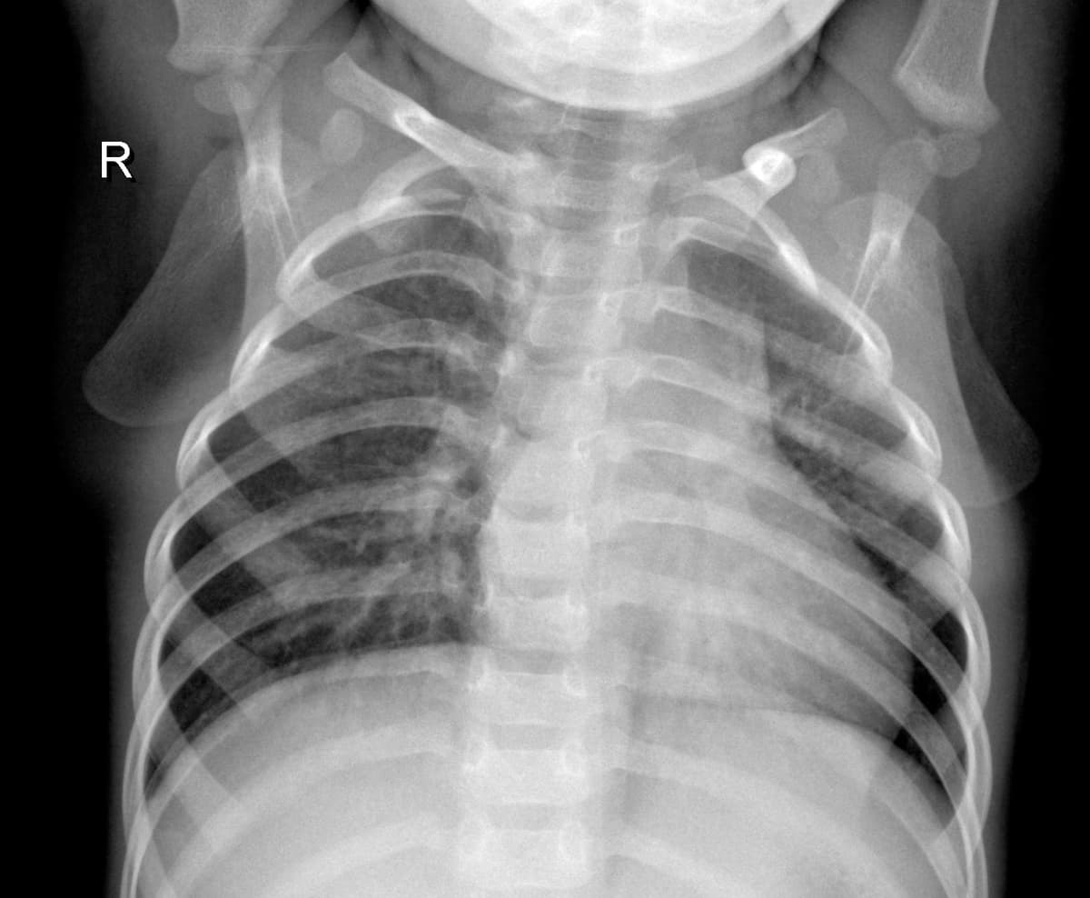 Radiografia Normal — NIH Chest X-ray14