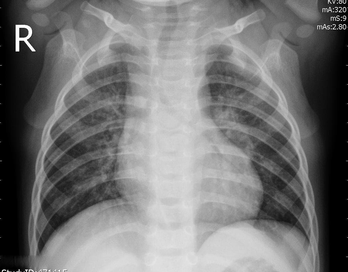 Pneumonia — NIH Chest X-ray14