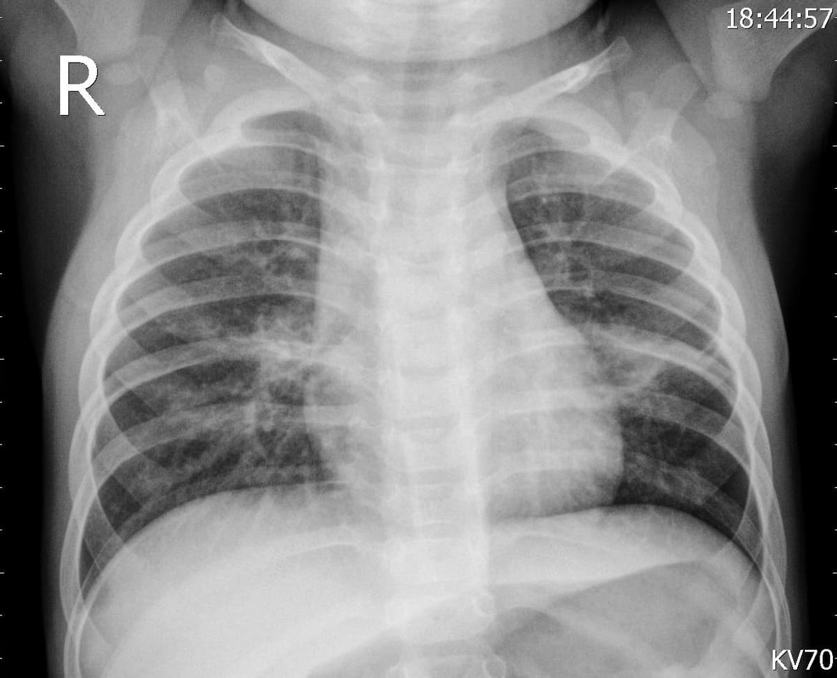 Pneumonia — NIH Chest X-ray14