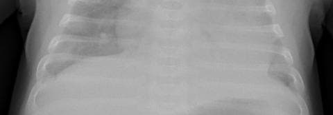 Pneumonia — NIH Chest X-ray14