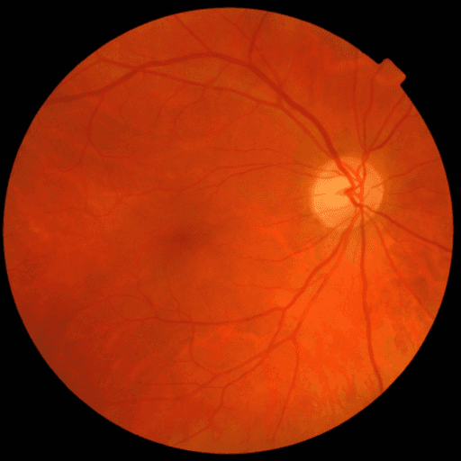No Diabetic Retinopathy — MESSIDOR-2