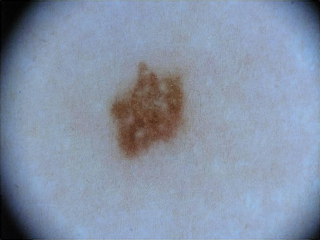 Melanocytic Nevus — ISIC Archive