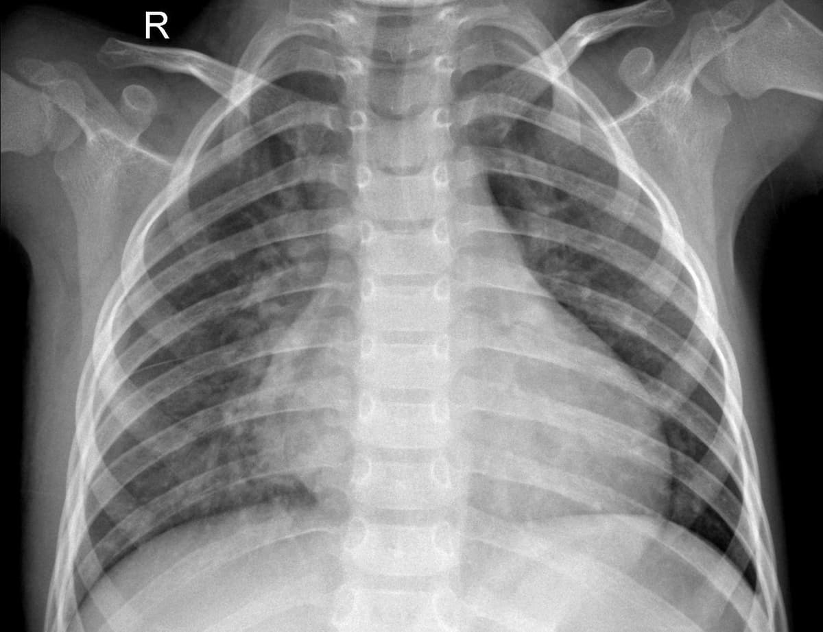 Pneumonia — NIH Chest X-ray14