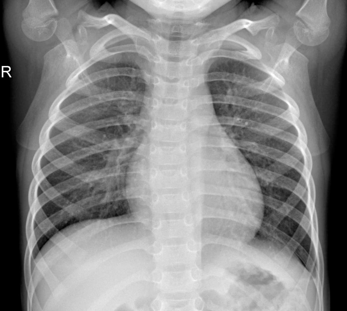Radiografia Normal — NIH Chest X-ray14