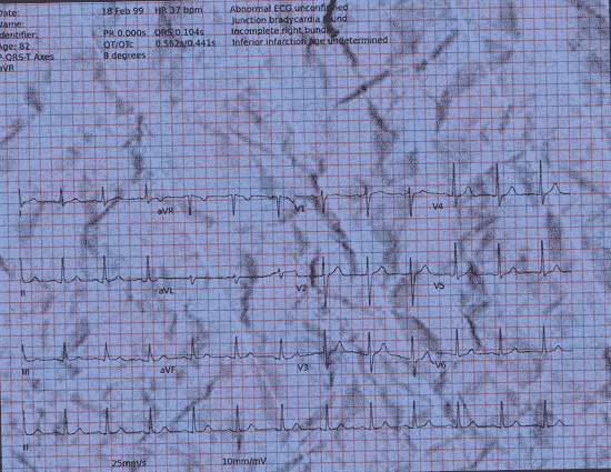 Normal ECG — PTB-XL