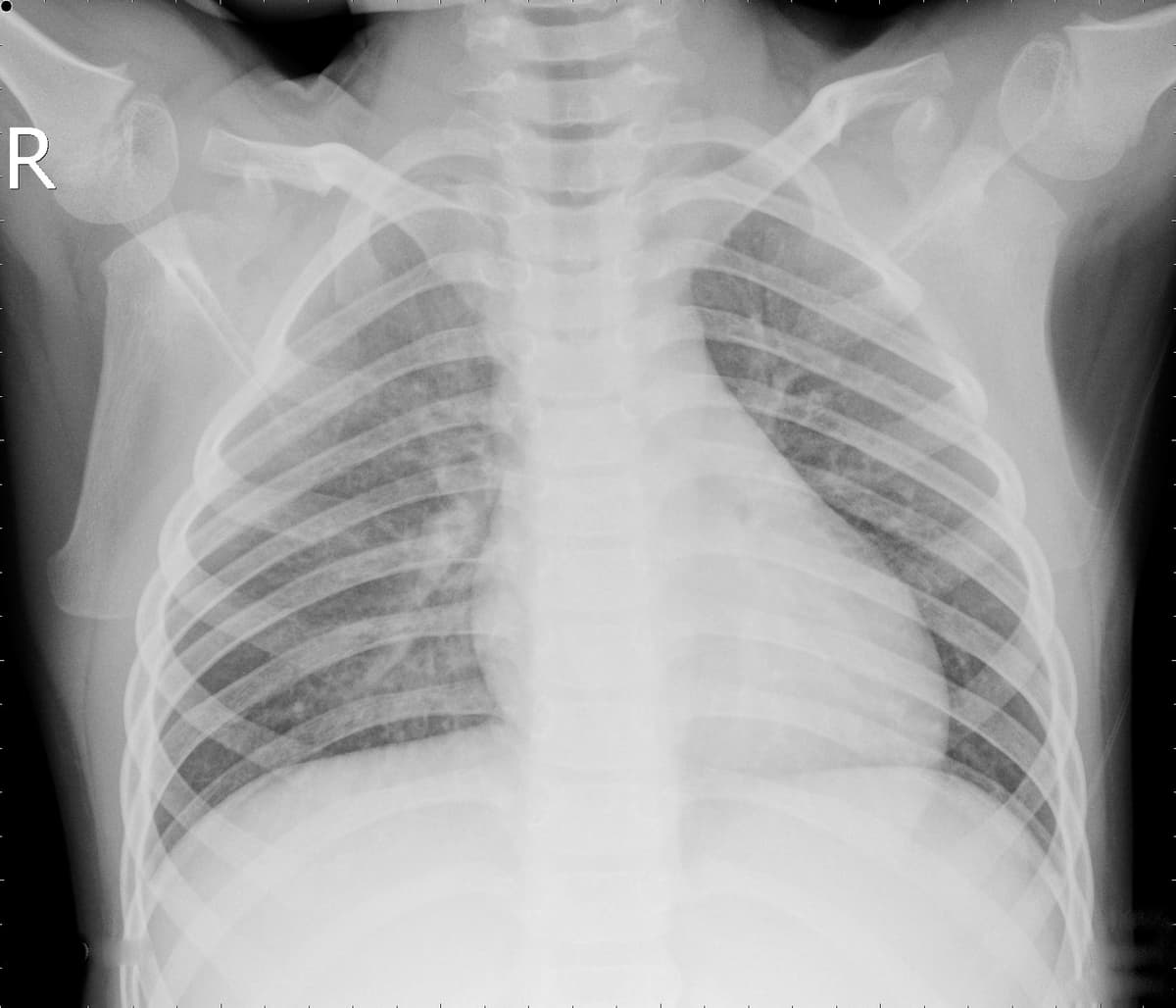 Radiografia Normal — NIH Chest X-ray14