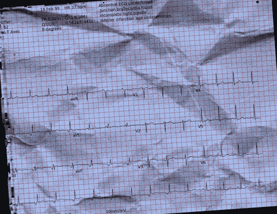 Normal ECG — PTB-XL