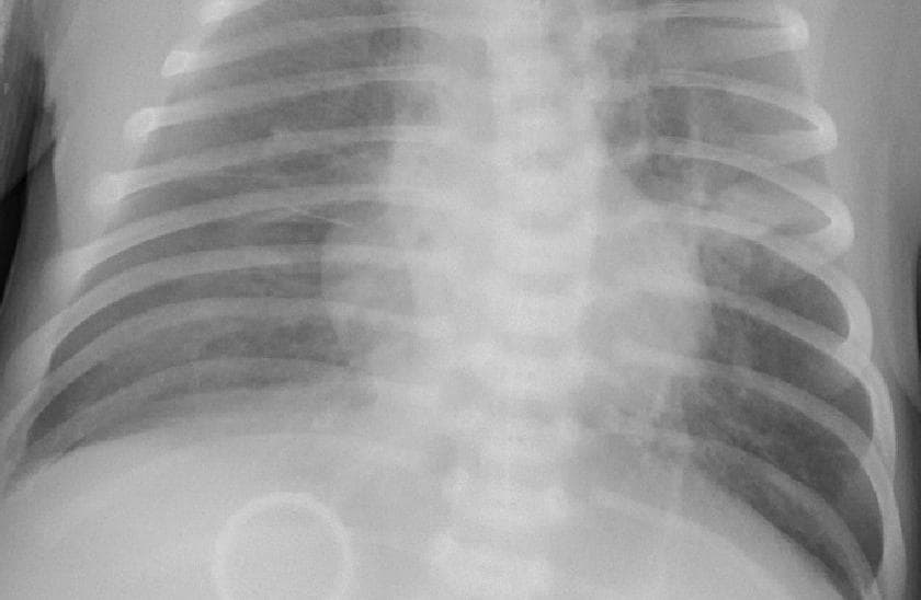 Pneumonia — NIH Chest X-ray14